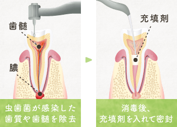 虫歯菌が感染した歯質や歯髄を除去し、消毒後充填剤を入れて密封