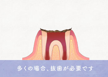 多くの場合、抜歯が必要です