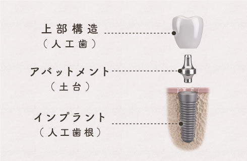 上部構造・アバットメント・インプラント