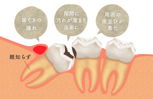 歯ぐきの腫れ、隙間に汚れが溜まり虫歯に、周囲の歯並びが悪化